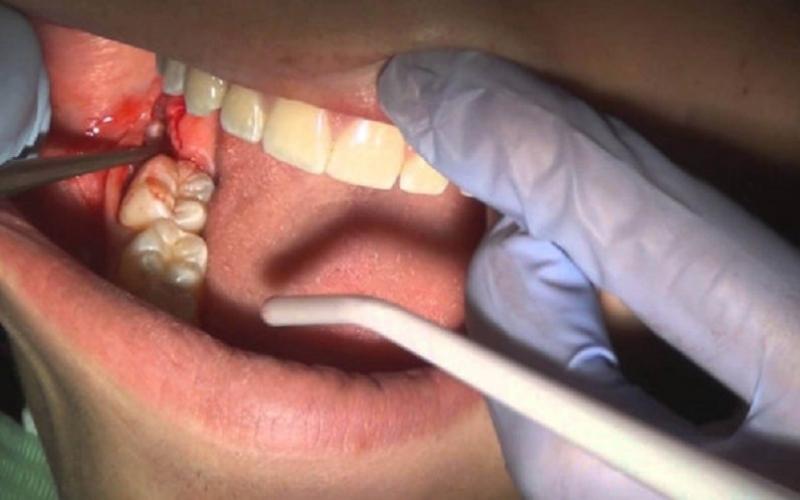 Tình trạng áp xe răng khôn