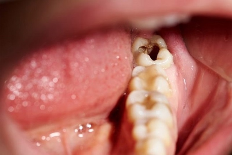 Sâu răng là những tình trạng thường gặp ở răng hàm số 6
