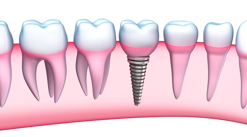 Trồng răng Implant là giải pháp tối ưu để phục hình răng đã mất