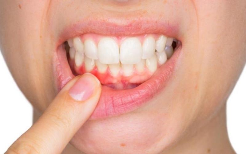 Lợi bị sưng tấy là ảnh hưởng của viêm tủy răng không được điều trị sạch