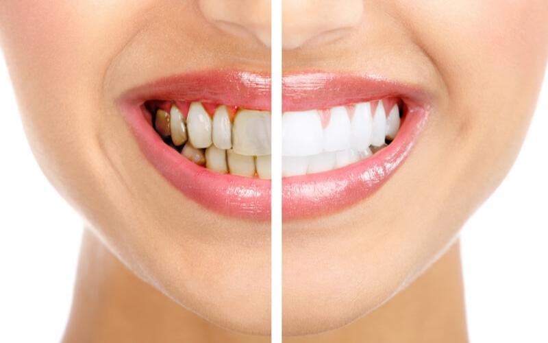 Khách hàng nên tẩy trắng răng 1-2 năm/lần