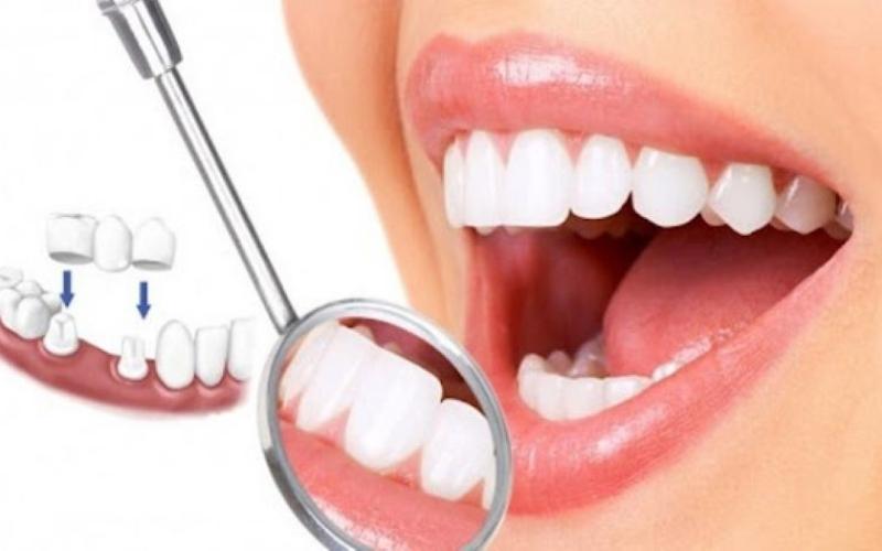 Những năm gần đây nhu cầu bọc răng sứ tại Nha Trang có xu hướng tăng lên đáng kể