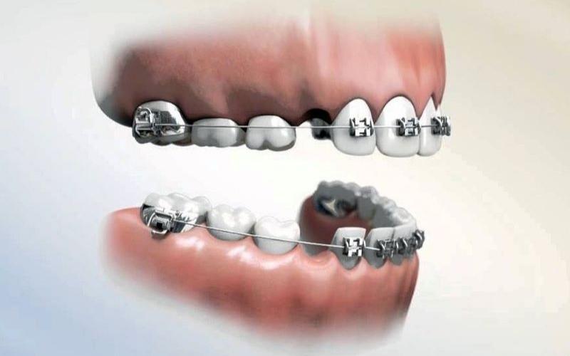 Tùy vào tình trạng răng mà bác sĩ sẽ chỉ định có nhổ răng khôn hay không