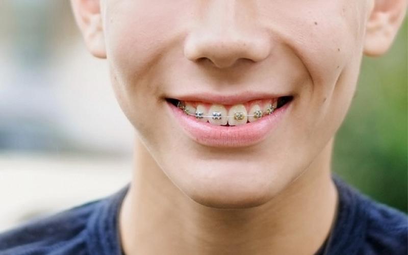 Niềng răng cố định là kỹ thuật gắn mắc cài vào hàm răng trong suốt quá trình chỉnh nha