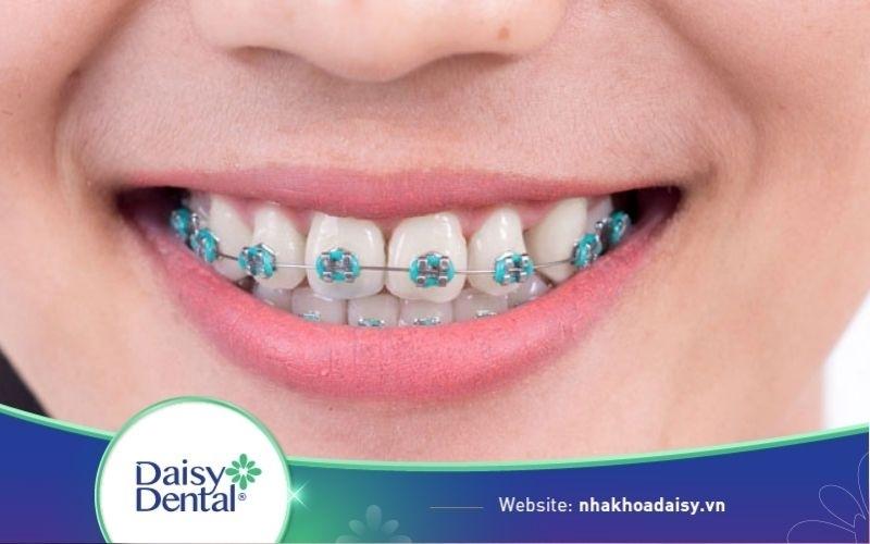 niềng răng cửa bị hô