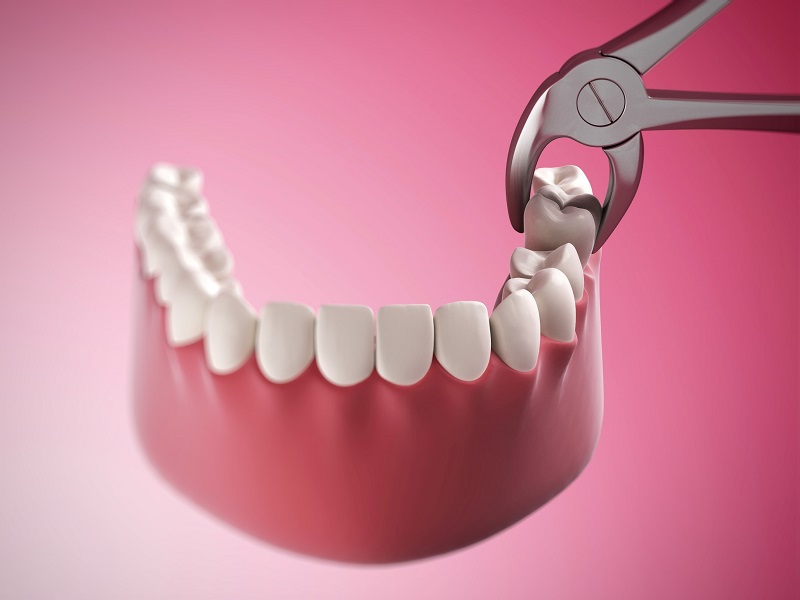 Răng cấm bị sâu cần phải nhổ bỏ