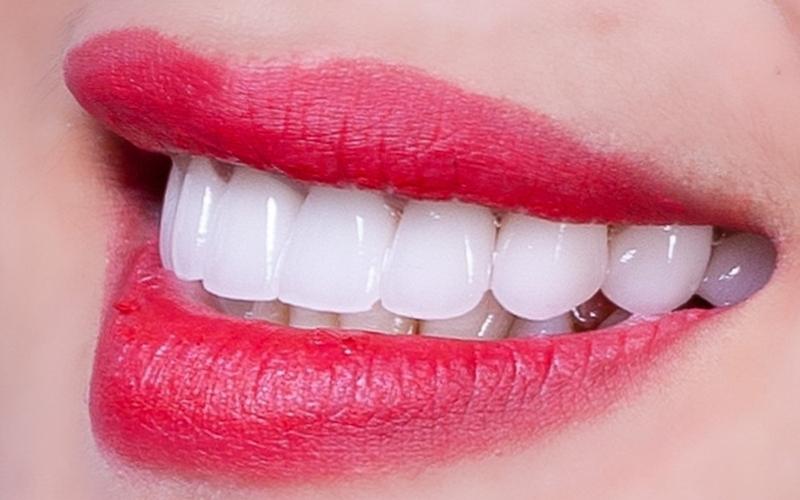 Răng sứ Cercon có giá từ 5 triệu đến 7 triệu