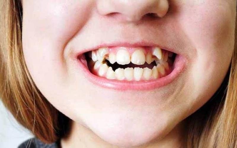 Tình trạng răng lệch lạc