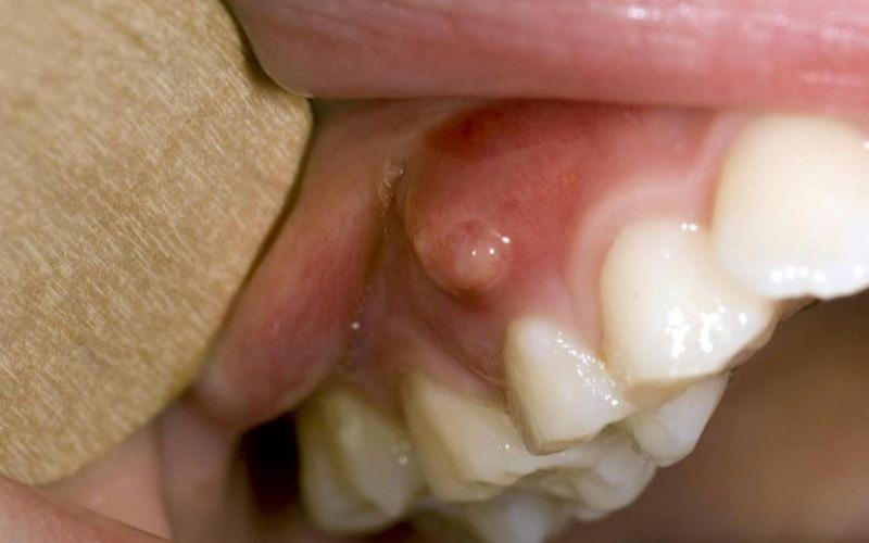Bệnh lý áp xe răng không thể tự khỏi được