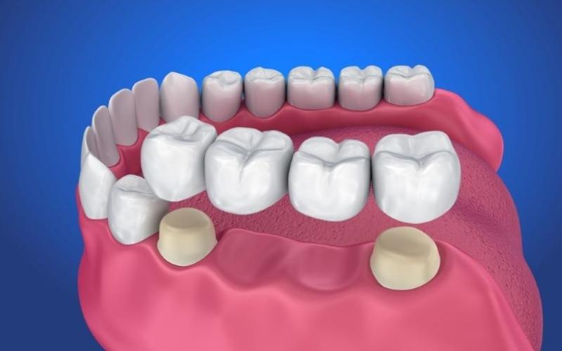 Cầu răng sứ là giải pháp phục hình răng đã mất hiệu quả