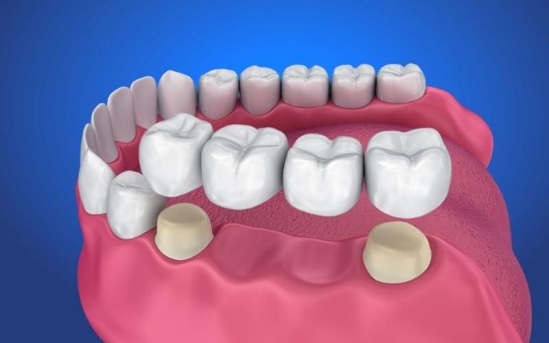 Phương pháp cầu răng sứ được nhiều người lựa chọn để khắc phục tình trạng mất răng