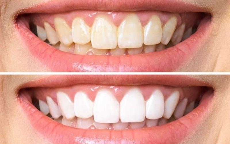 Tẩy trắng răng Bleachbright an toàn, lành tính với người dùng