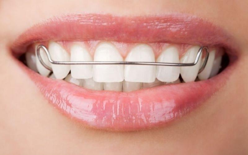 Đeo hàm duy trì giúp hạn chế tình trạng niềng răng xong bị hô