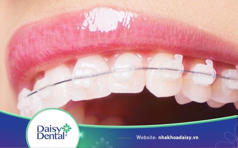 niềng răng mắc cài sứ giá bao nhiêu