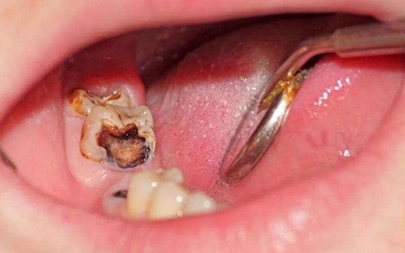 Hình ảnh mô tả tình trạng sâu răng
