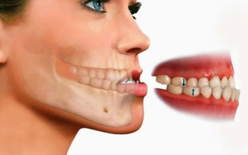 Hình ảnh mô phỏng tình trạng răng móm nhẹ