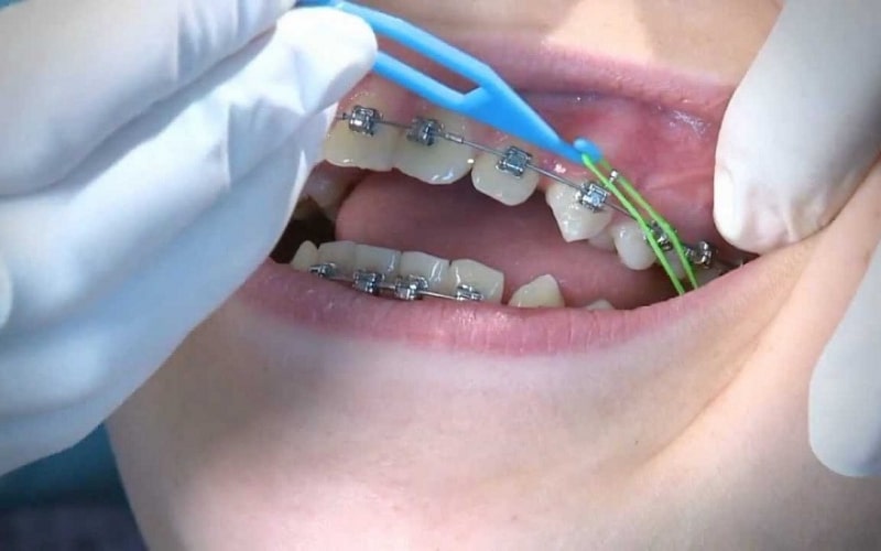 Dây thun niềng răng là một khí cụ quan trọng trong quá trình chỉnh nha