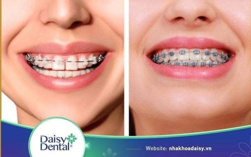 nên niềng răng mắc cài sứ hay kim loại