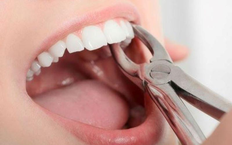 Nhổ răng số 4 không gây ảnh hưởng đến sức khỏe răng miệng