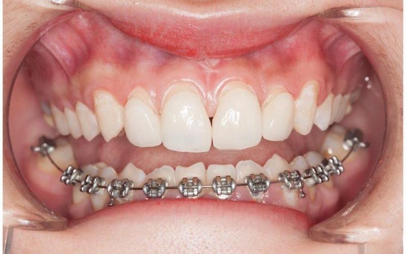 Một số trường hợp có thể niềng răng hàm dưới