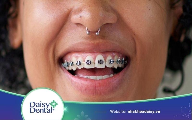 Niềng răng hô mất bao lâu? Quy trình niềng răng hô như thế nào?