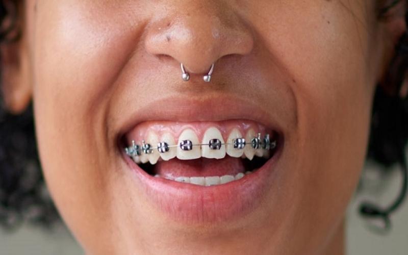 Niềng răng hô khắc phục khuyết điểm răng miệng