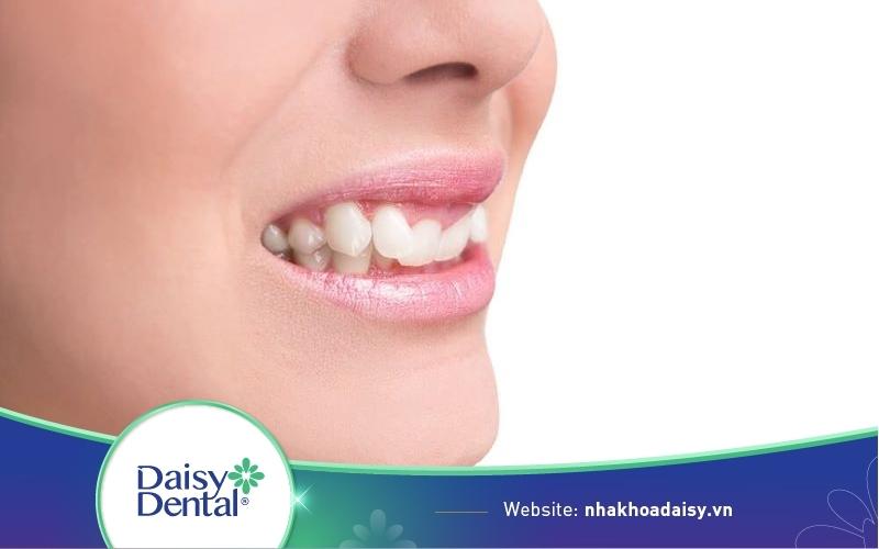 niềng răng khớp cắn sâu