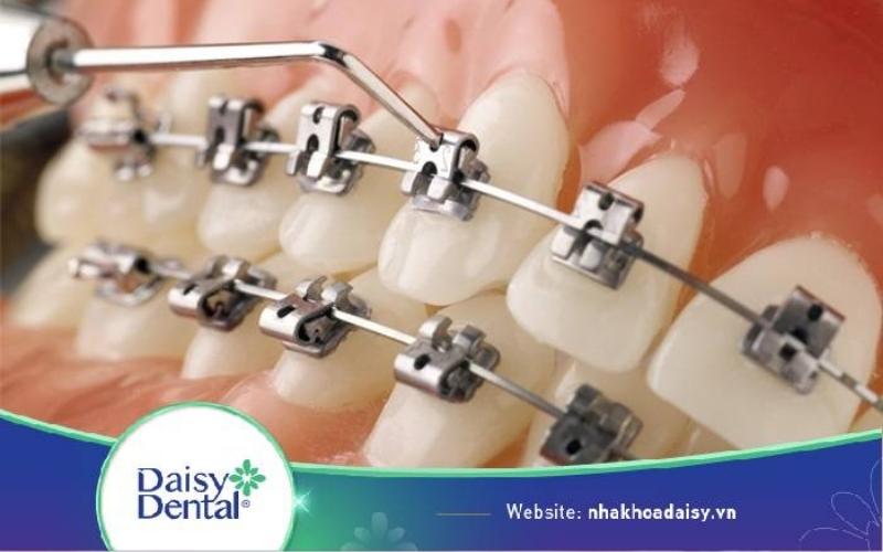niềng răng mắc cài kim loại tự buộc