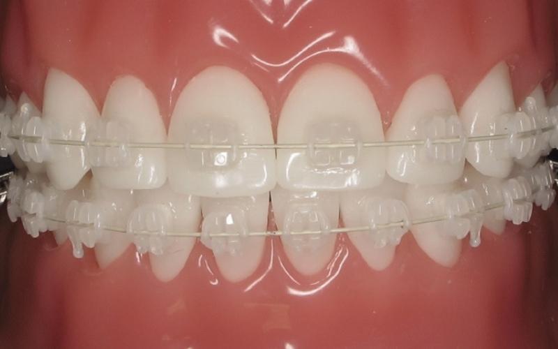 Niềng răng mắc cài sứ có màu sắc tương đồng với răng thật nên được đánh giá cao về độ thẩm mỹ