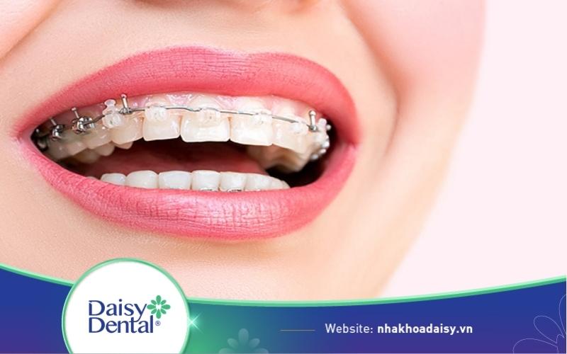 Niềng răng mắc cài sứ dây trong
