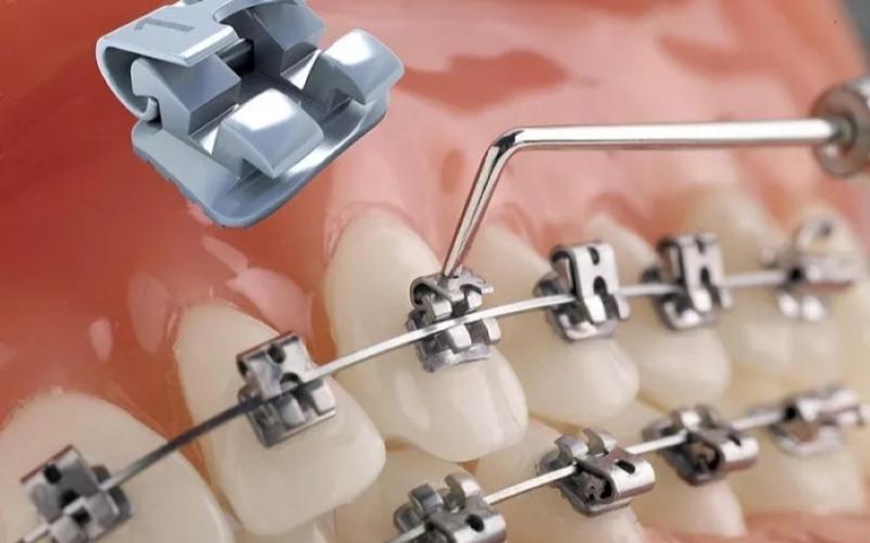 Niềng răng tự buộc có các nắp trượt tự động dễ dàng đóng mở