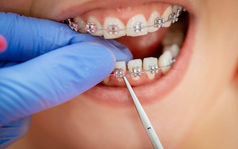 Việc nhổ răng thường được hạn chế hết mức