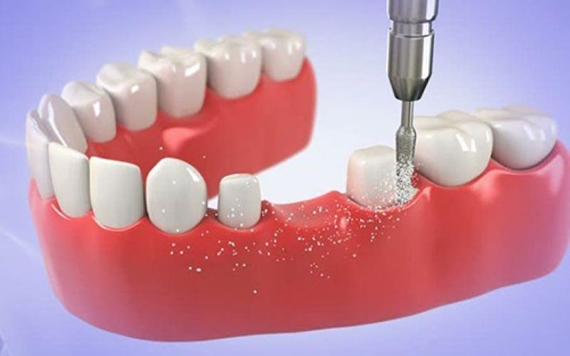 Phương pháp làm cầu răng sứ sẽ mài hai chiếc răng bên cạnh răng mất để làm trụ cầu
