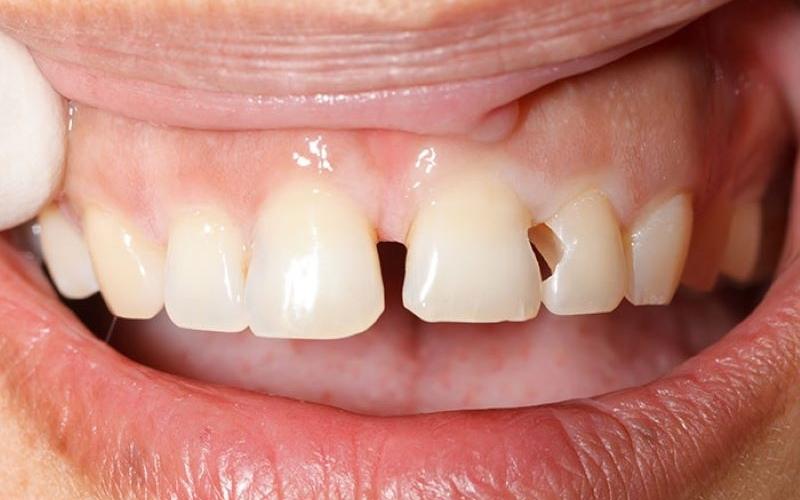 Răng bị gãy vỡ có thể sử dụng loại răng sứ này để khắc phục