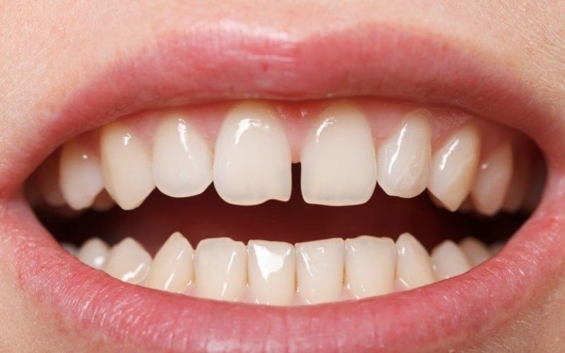 Răng thưa là tình trạng các răng mọc xa cách nhau