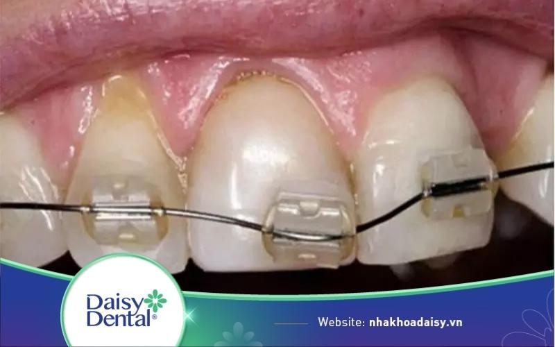 Rớt mắc cài niềng răng