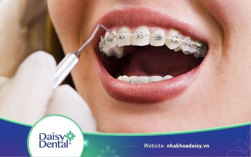 niềng răng mắc cài kim loại thường