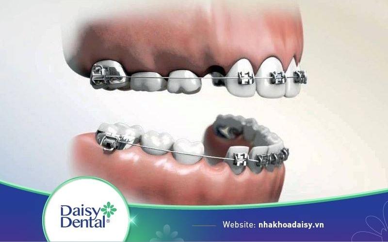 Niềng răng nhổ 8 cái