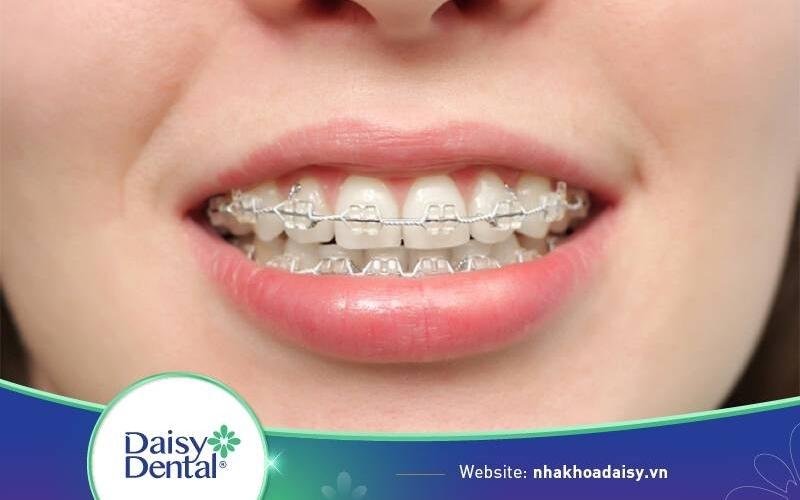 niềng răng xong bị hô