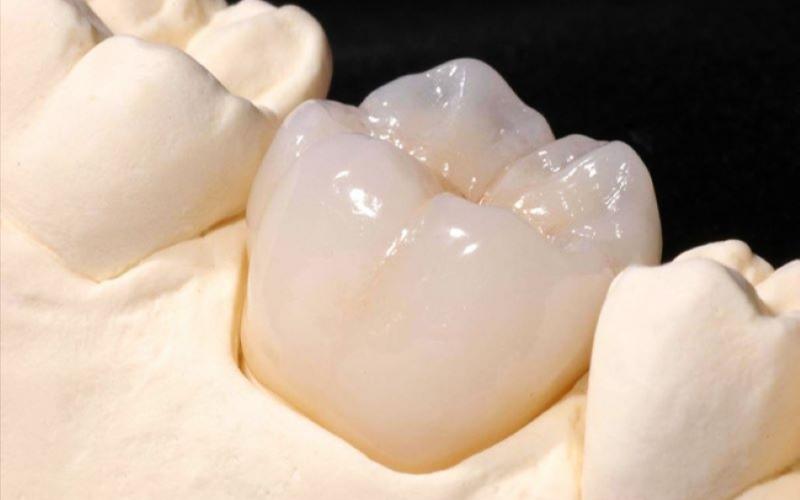 Răng sứ Ceramco thuộc nhóm răng sứ kim loại