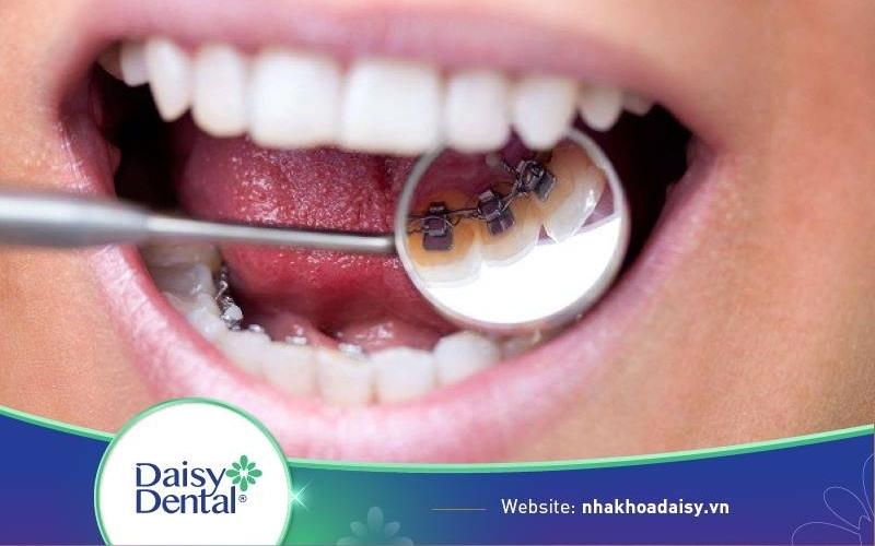 Sâu răng có niềng răng được không