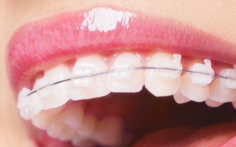 Niềng răng mắc cài sứ là phương pháp sử dụng mắc cài làm từ chất liệu sứ
