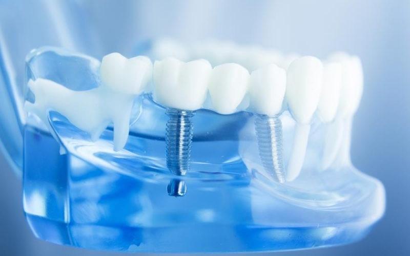 Trồng răng Implant là kỹ thuật trồng răng sứ vĩnh viễn hiện đại