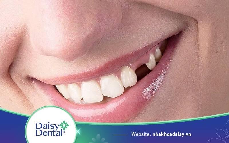 Trồng răng sứ vĩnh viễn giá bao nhiêu