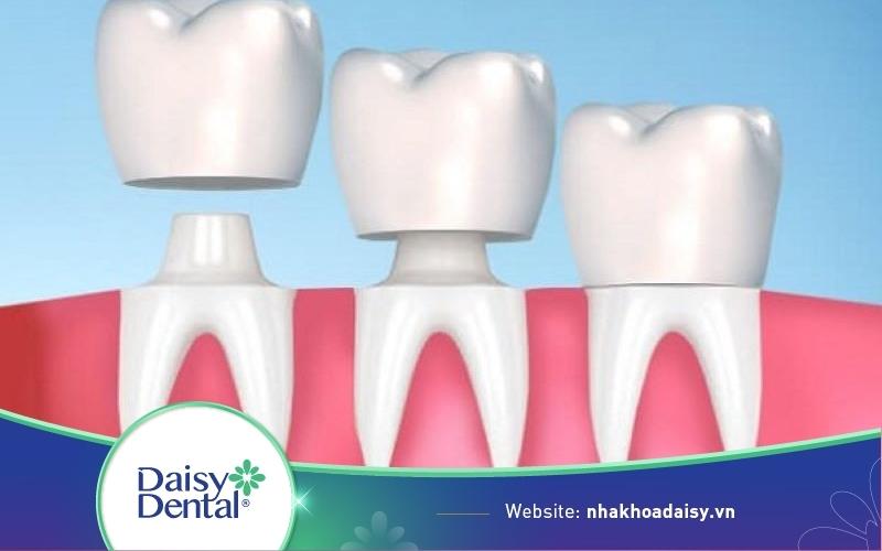 bao nhiêu tuổi thì bọc răng sứ được