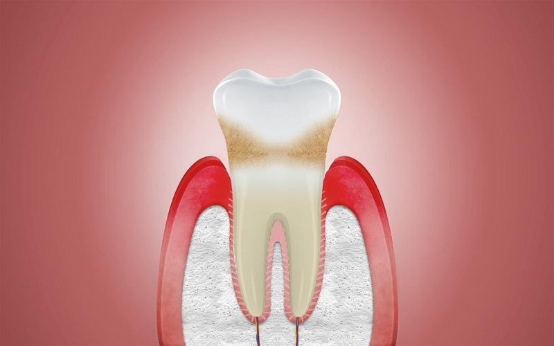 Bọc răng sứ không đúng kỹ thuật có thể gây ra biến chứng tụt lợi