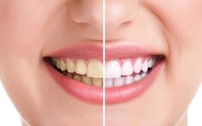 Bọc răng sứ khắc phục được khuyết điểm răng ố vàng xỉn màu