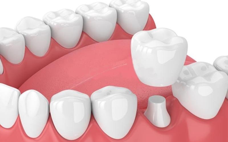 Bọc răng sứ là kỹ thuật được áp dụng khi răng mẻ, thưa nhẹ, ố vàng,...