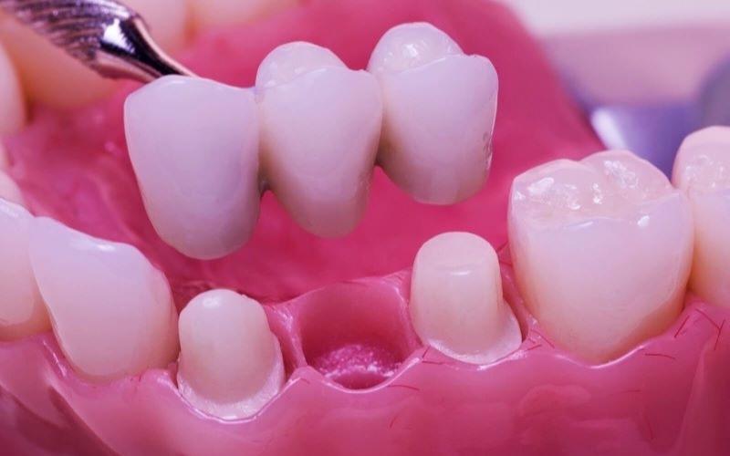 Khách hàng có thể lựa chọn nhiều loại răng sứ để bắc cầu