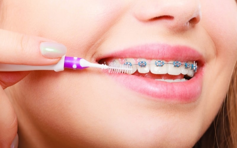 Cần chú ý chăm sóc răng miệng thật kỹ sau khi niềng